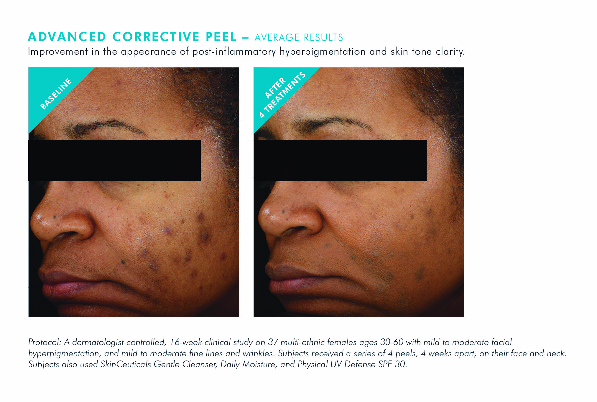 Before and after chemical peel treatment — improvement in hyperpigmentation and skin clarity after 4 treatments
