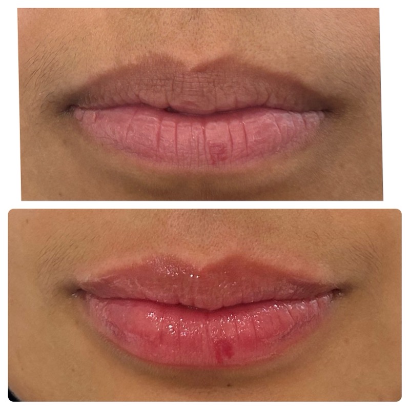 Lip filler before and after — natural shape definition