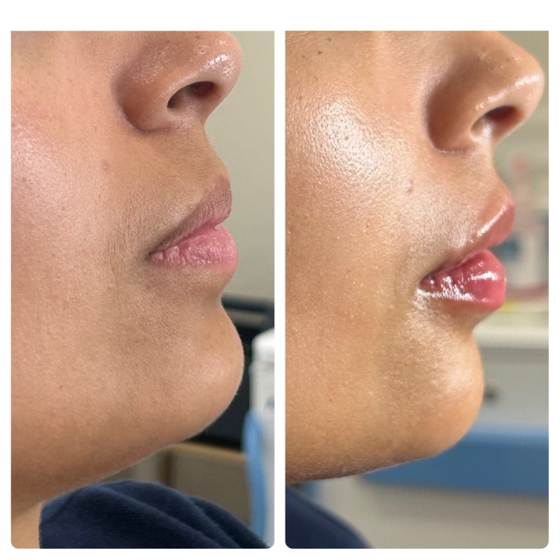 Lip filler before and after — subtle fullness enhancement
