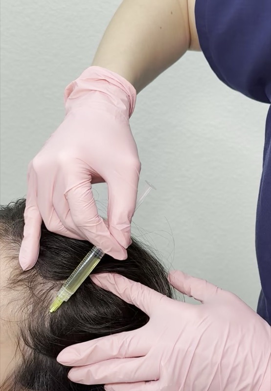 PRP injection into scalp for hair restoration treatment